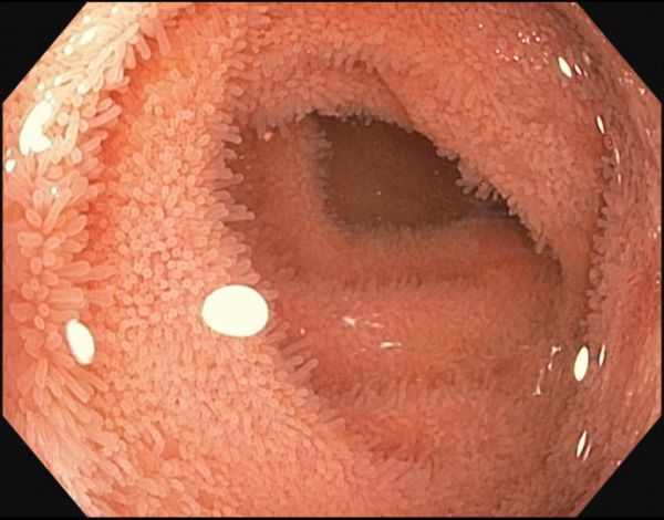 Blick in einen normalen Dünndarm (Ileum)