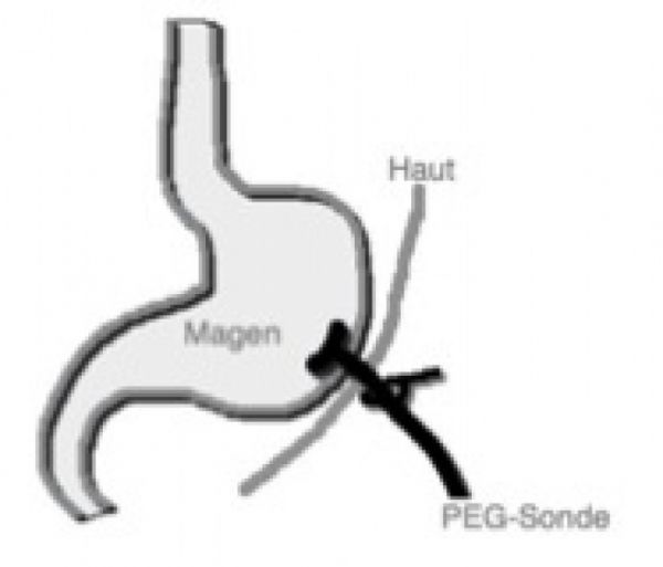 PEG Sonde